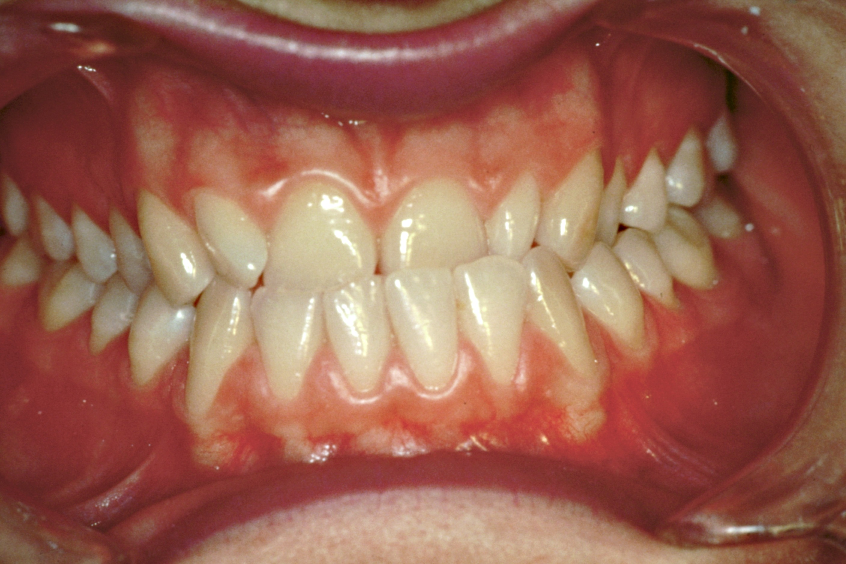 Troubles temporo-mandibulaires